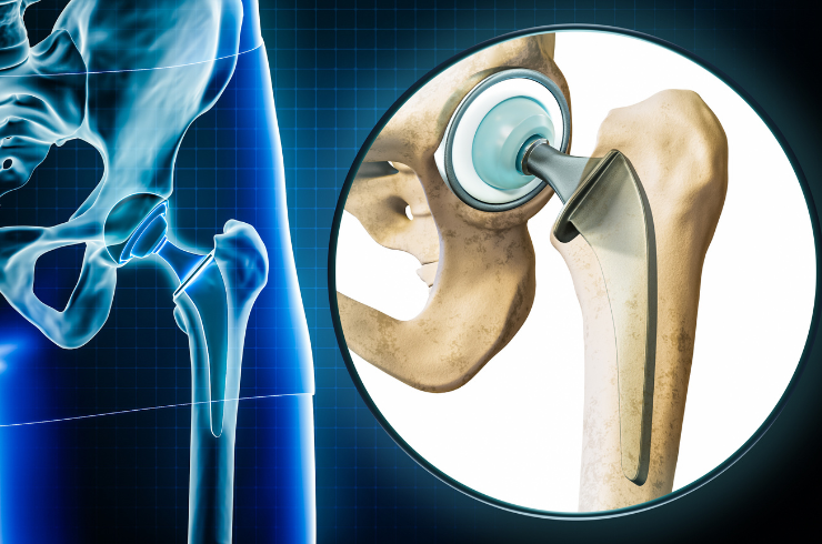 Joint Replacement