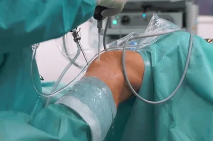 Knee Arthroscopy