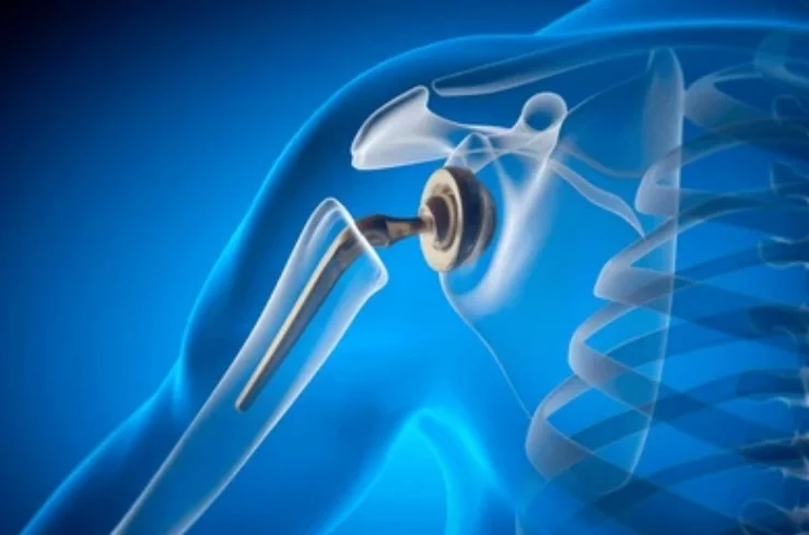 Shoulder Replacement Surgery---------12